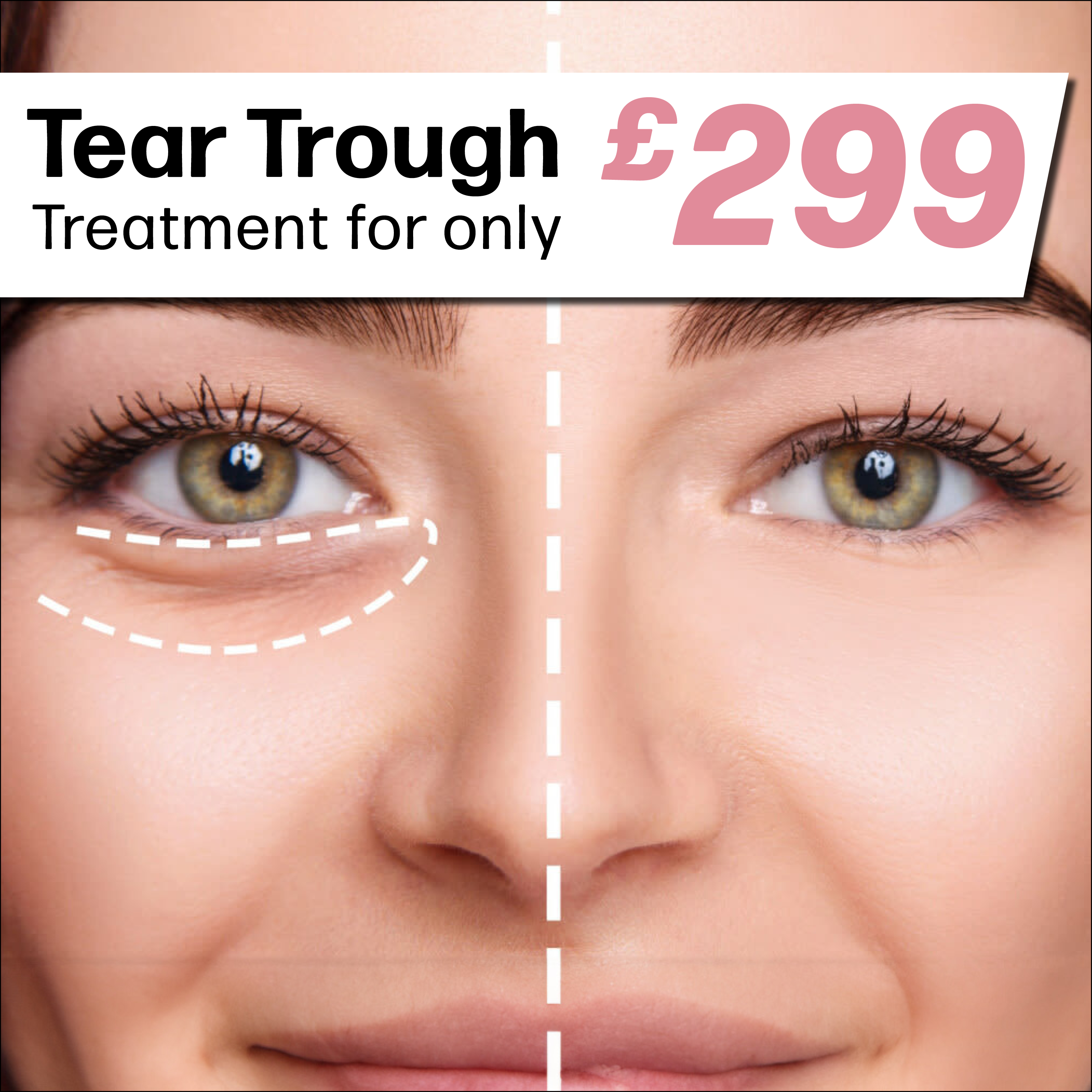 Tear Trough £299